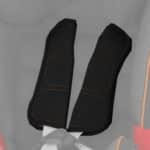 Coussinets Advansafix II (SICT)